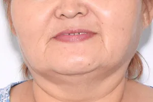 Восстановление верхней челюсти на шести имплантах, фото до