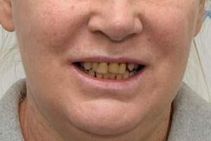 Восстановление зубов по протоколу All-on-6 за 1 день, фото до