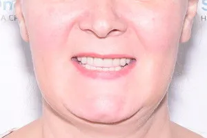 All-on-6 на имплантах Straumann для обеих челюстей, фото после