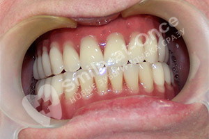 Комплексное восстановление зубов методом All-on-6