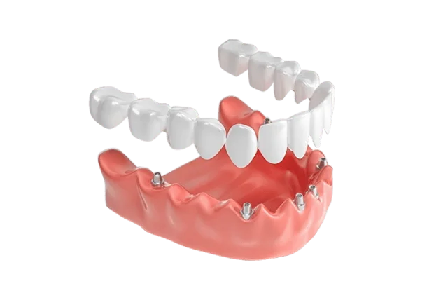 ALL-ON-6 - Протезирование на 6 имплантах