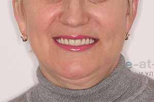 Восстановление разрушенных зубов обеих челюстей