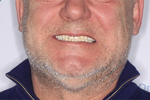 Восстановление зубов имплантатами фото до