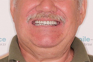 Восстановление зубов после зубных коронок