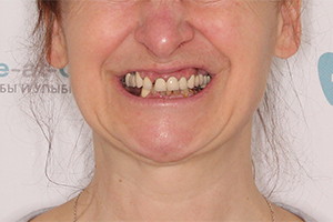 Комплексная базальная имплантация зубов
