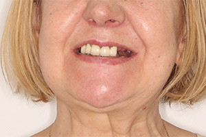 Имплантация зубов верхней челюсти фото до