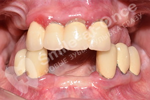 Восстановление зубов на двух челюстях за 3 дня
