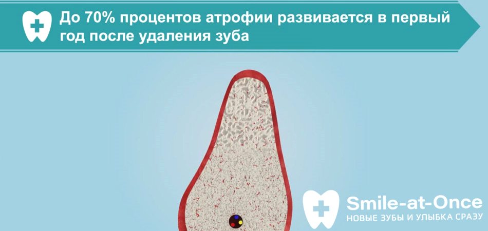 Видео об атрофии костной ткани после удаления зубов