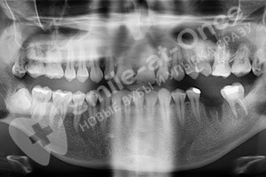 Восстановление одного зуба имплантом