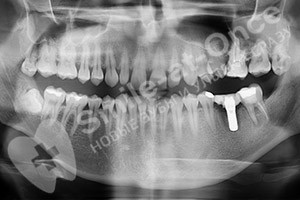 Восстановление одного зуба имплантом