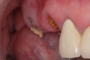 Восстановление жевательных зубов имплантами, фото до
