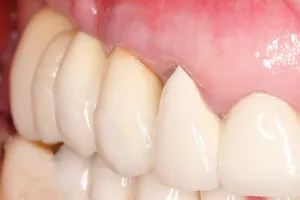 Восстановление жевательных зубов имплантами, фото после