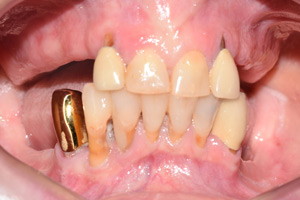 Восстановление разрушенных и отсутствующих зубов - протезирование All-on-4