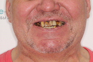 Пациент из Мурманска после комплексной имплантации зубов