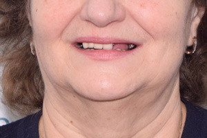 Базальная имплантация для восстановления зубов на обе челюсти, фото до