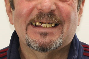 Новые зубы на 3й день