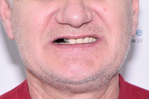 Новые зубы на имплантах Biomed, фото до