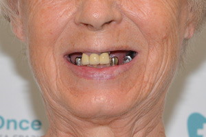 Новые зубы для пациентки из Иркутской области