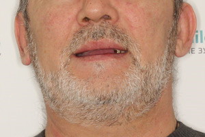 Восстановление зубов по протоколу BasalComplex, фото до