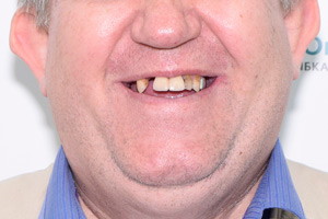 Замена зубов в кратчайшие сроки