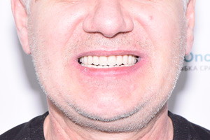 Новые зубы на имплантах Biomed