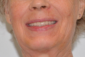 Новые зубы для пациентки из Иркутской области