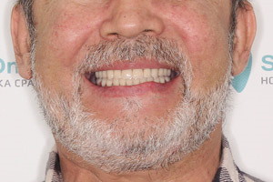 Восстановление зубов по протоколу BasalComplex