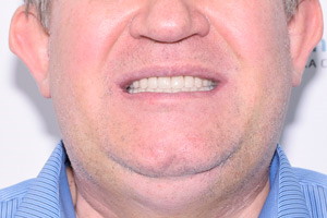 Замена зубов в кратчайшие сроки, фото после