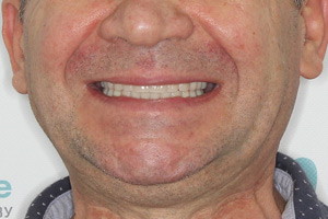 Базальные комплексы на обе челюсти, фото после