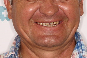 Восстановление зубов обеих челюстей имплантацией