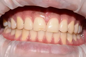 Реставрация переднего зуба и отбеливание всех зубов, фото до