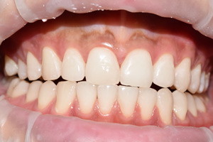 Реставрация переднего зуба и отбеливание всех зубов, фото после