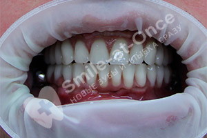 Восстановление зубов с помощью базальной имплантации
