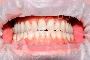 Базальная имплантация зубов верхней челюсти