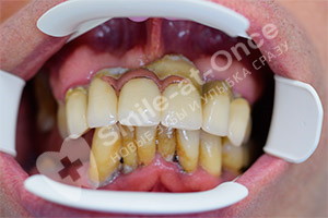 Восстановление зубов при помощи базальной имплантации