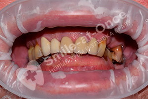 Базальная имплантация зубов на обеих челюстях