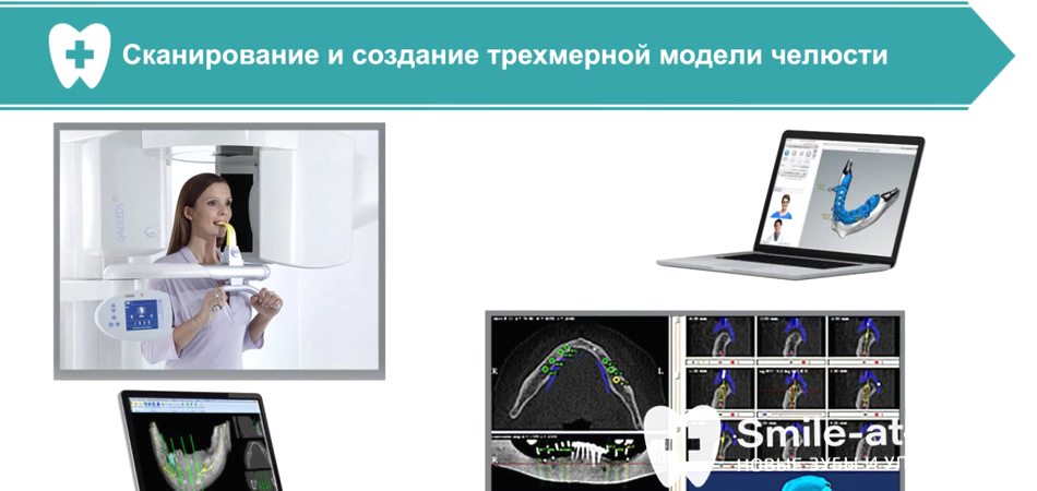 Видео о базальной имплантации всех зубов за 3 дня