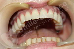 После проведения базальной имплантации зубов