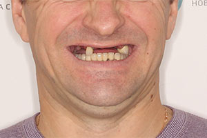 Новые зубы верхней челюсти за 3 дня