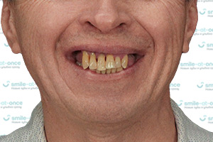 All-on-6 при пародонтите – зубы за 1 день без наращивания кости ДО