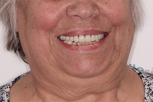 Имплантация зубов после зубного моста
