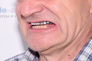 BASAL COMPLEX FULL на замену старым коронкам и проблемным зубам - до