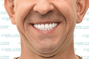 Имплантация All-on-4 – все зубы за 1 день ПОСЛЕ