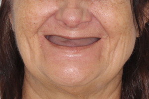 All-on-4 на 4х имплантах Zygoma, фото до
