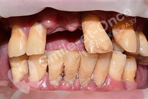 Имплантация для восстановления зубов после пародонтоза