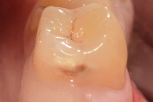 Кариес жевательного зуба, фото до