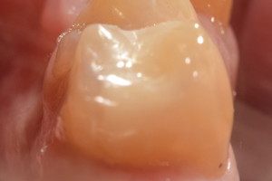 Кариес жевательного зуба, фото после