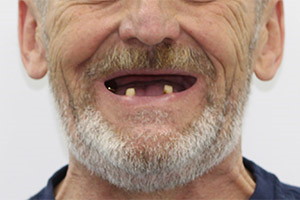 Комбинация методов имплантации для восстановления зубов