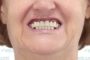 Все зубы All-on-4 с постоянными протезами ДО