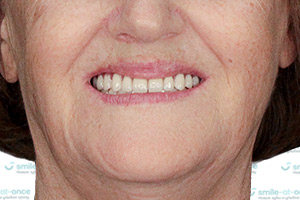 Все зубы All-on-4 с постоянными протезами ПОСЛЕ